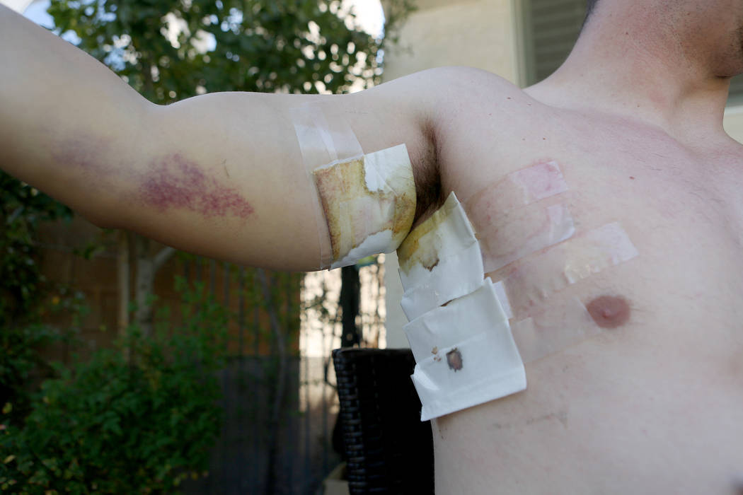 Las Vegas police officer Brady Cook shows his scars in his home in Las Vegas on Sunday, Oct. 8, 2017. Cook was on his second day of field training when he was shot during the Route 91 Harvest fest ...