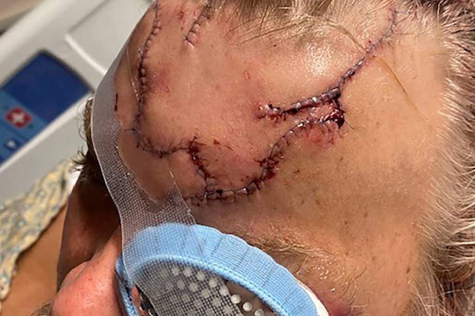 Lacerations are seen on Allen Minish's head as he recuperates at a hospital in Anchorage, Alask ...