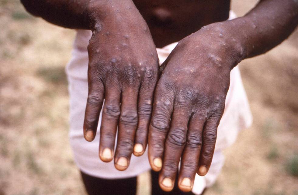 This 1997 image provided by the CDC during an investigation into an outbreak of monkeypox, whi ...