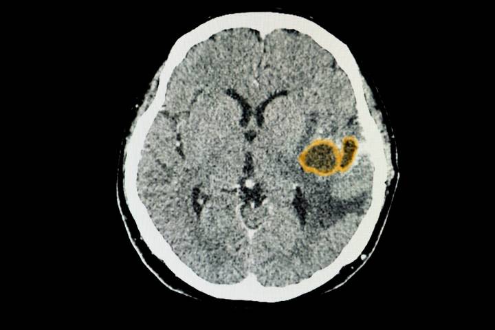 A CT brain scan of a patient with large brain abscesses in her left temporal lobe. (Getty Images)