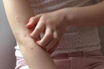 The best way to treat eczema is to avoid triggers that cause a flare. (Getty Images)