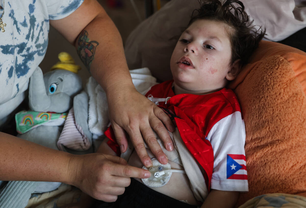 Heidi Tunea shows her 5-year-old son Danyel Velez’s feeding tubes at their home in Las Vegas ...